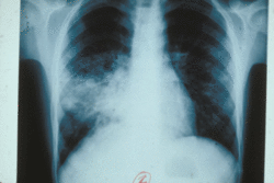 inserm 4336 raille relle medium