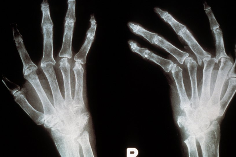 Radiographie de mains de patient atteint de polyarthrite rhumatoïde