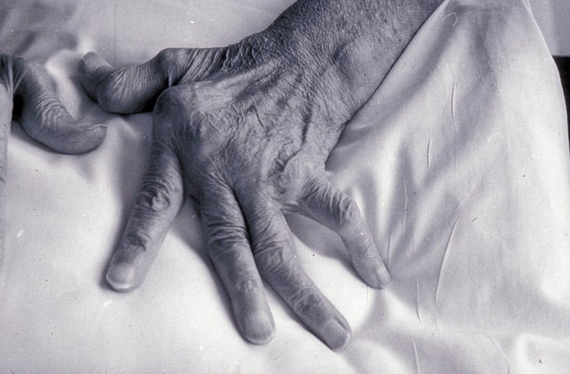 La main d'une personne âgée, les articulation des doigts sont déformées.