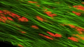 Trabéculum glaucomateux : raréfaction majeure des cellules trabéculaires (iodure de propidium). La coloration verte est due à l’autofluorescence de l’élastine constitutive des mailles trabéculaires.