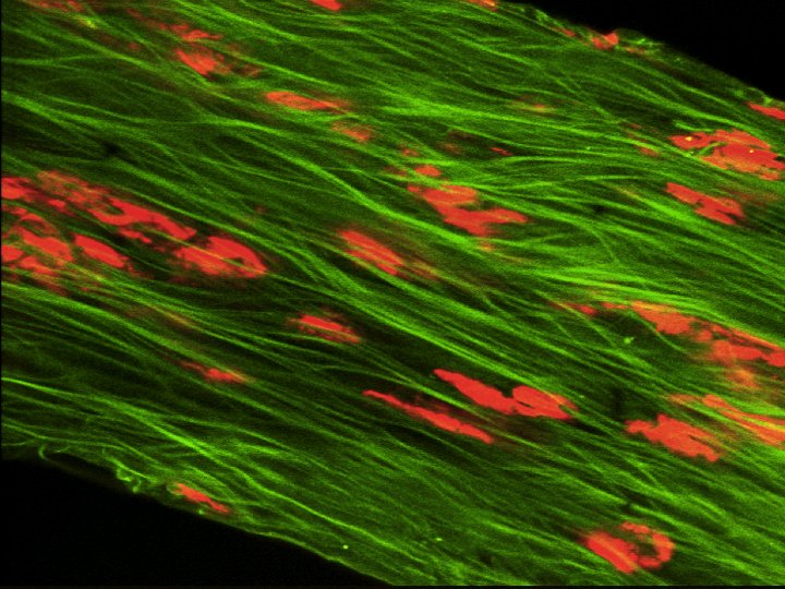Trabéculum glaucomateux 